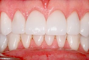 Dr. Timothy N. Smith Cosmetic, Family and Implant Dentistry | Ceramic Crowns, Veneers and All-on-6 reg 